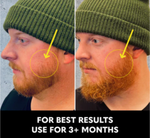 beard roller